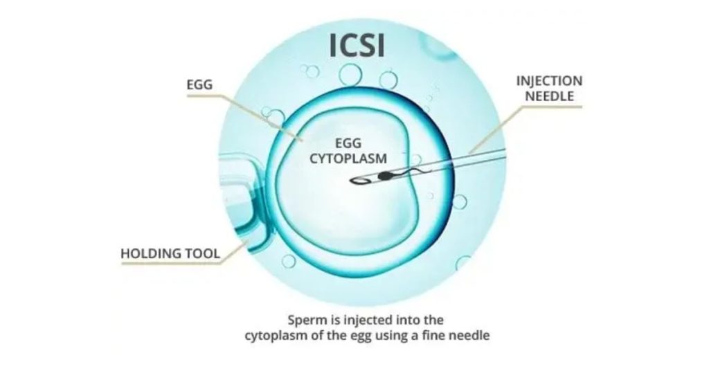 ICSI treatment in indore